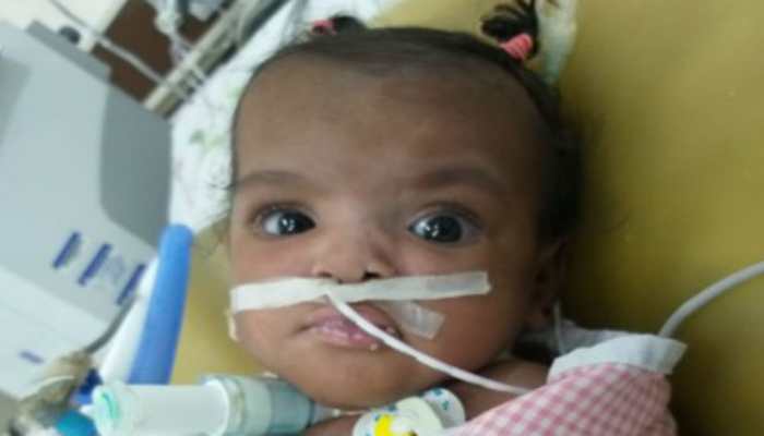 Bengaluru doctors perform rare surgery to separate conjoined twins from Mauritius
