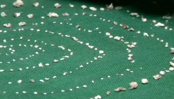 Chennai doctors extract 526 teeth from 7-year-old's mouth