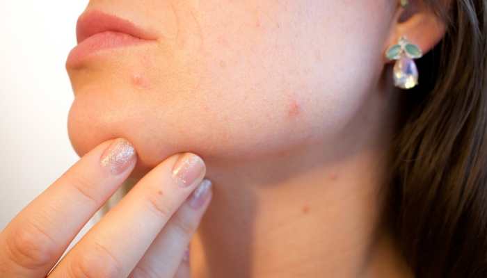 skin cancer | Zee News