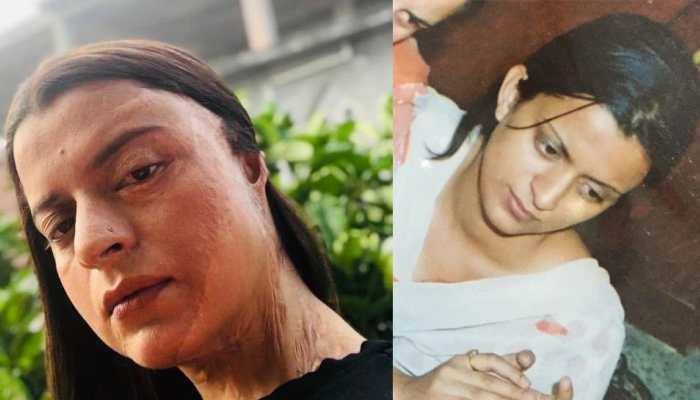 Rangoli Chandel shares her heart-warming acid attack ordeal on Twitter