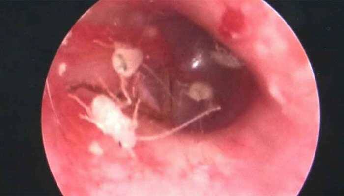 Watch: Doctor finds family of cockroaches living inside man's ear in China, video goes viral