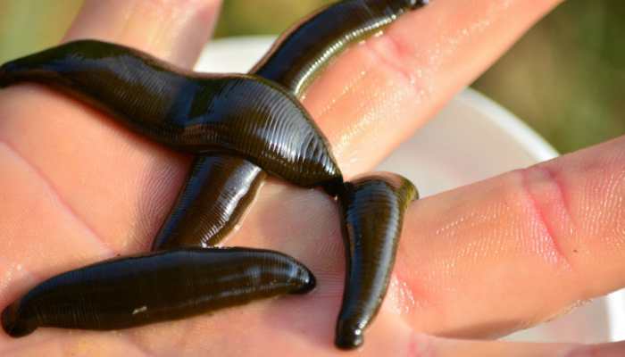Live leeches removed from China man&#039;s throat after he complained of coughing for two months