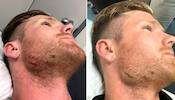 Don't reverse sweep into your face: Neesham's advice after hurting his chin