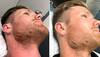 Don't reverse sweep into your face: Jimmy Neesham's advice after hurting his chin