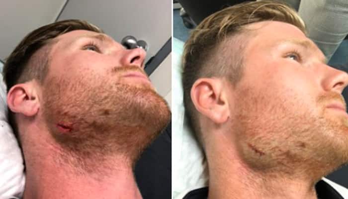 Don't reverse sweep into your face: Jimmy Neesham's advice after hurting his chin