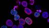 Scientists seek foot, mouth disease virus to fight pancreatic cancer