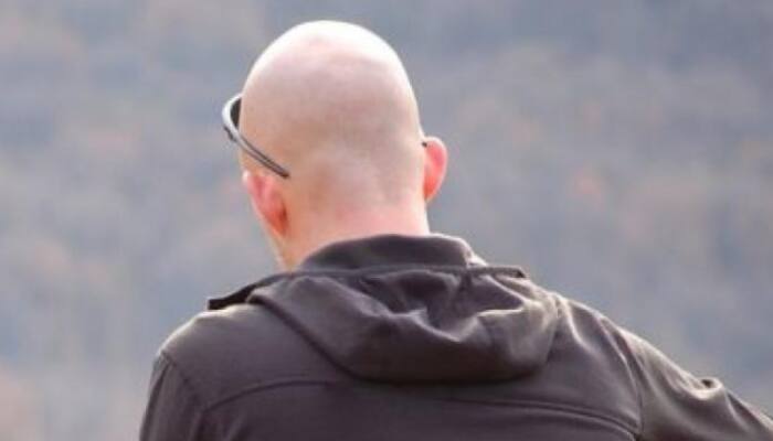 Bald men more vulnerable to COVID-19 symptoms; Check out reasons 