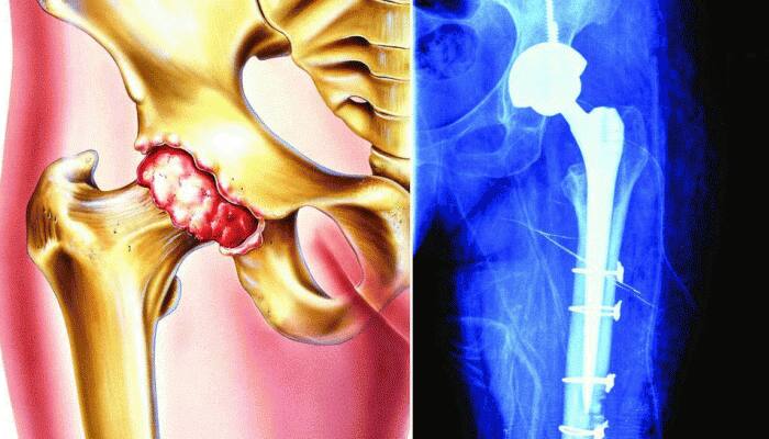 People with diabetes at greater risk of bone fractures: Study