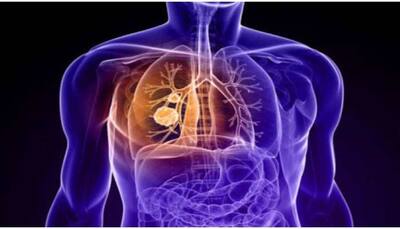 Indian researchers develop diagnostic therapy for lung cancer