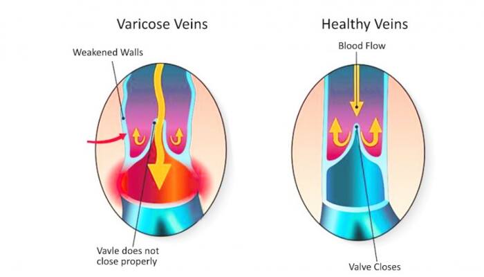 Varicose Veins, if ignored can lead to complications