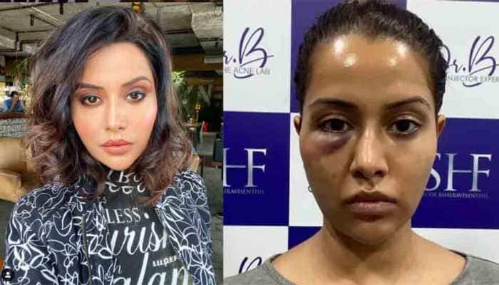Tamil actor Raiza Wilson &#039;forced&#039; to undergo dermatological procedure, shares photo after treatment goes wrong