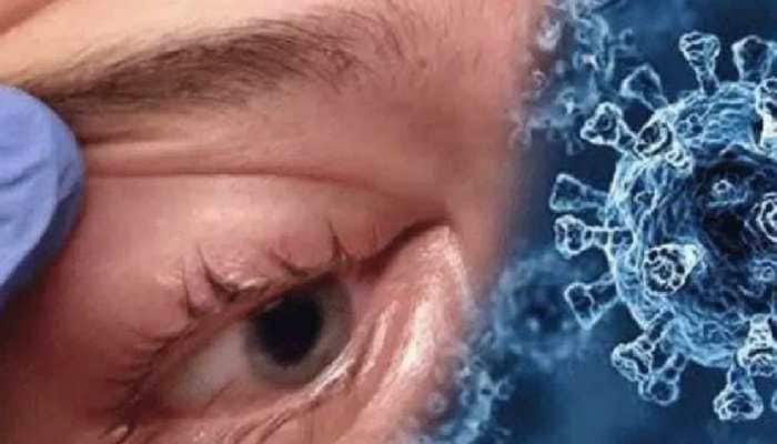 First ever case of 'Optic Neuritis' after black fungus; Kanpur authorities on alert