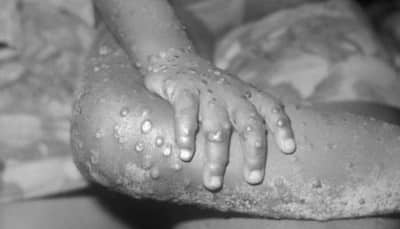 Monkeypox case reported in US after 18 years, check its symptoms and other details
