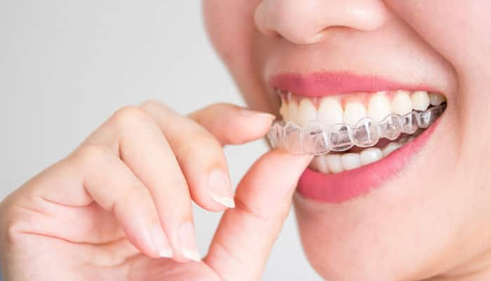 What Is Invisalign Treatment?