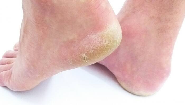 Troubled with dry cracked heels? Check out THESE natural ways to get rid of them