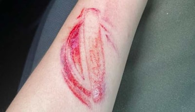 Airbag saved life, but leaves a wacky bruise on driver’s arm; check pics