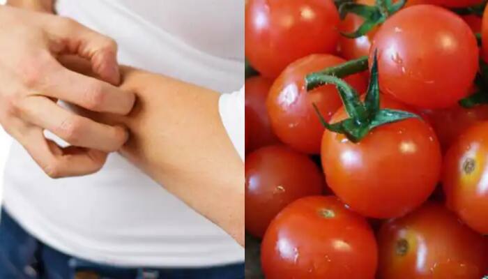 Tomato fever or HFMD virus in Kerala? Know causes and symptoms of Head, Foot and Mouth Disease