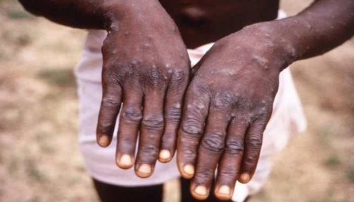 Monkeypox cases cross 100 in Europe, WHO calls emergency meeting