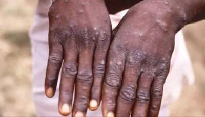 Monkeypox patients could be infectious for up to 4 weeks: Experts