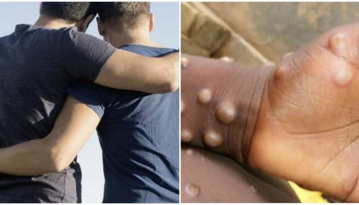 Monkeypox Virus: Does this spread through sex? 6 of newly affected were gay or bisexual men