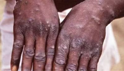 Monkeypox disease spreads to more countries, cases now reported in Israel, Switzerland and Austria