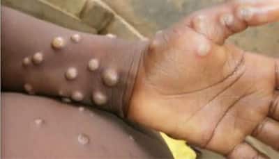 Monkeypox scare: Belgium becomes first country to introduce 21-day compulsory quarantine