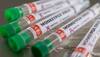 Monkeypox scare: Is Mumbai worried? BMC sets up special ward for suspected cases
