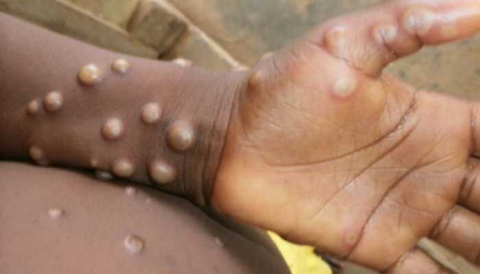 Tamil Nadu on high alert for suspected Monkeypox cases