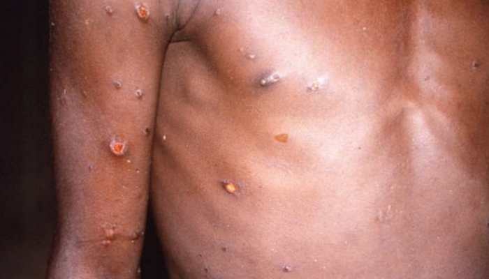 Monkeypox spread: Denmark and Scotland confirm first case