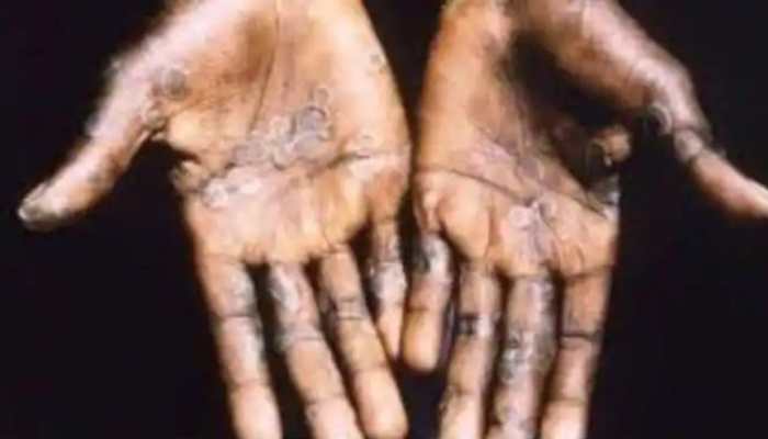 Monkeypox: WHO asks countries to increase surveillance as 200 cases confirmed in over 20 countries