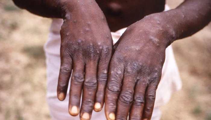 Monkeypox scare: Now, US confirms 9 cases across seven states