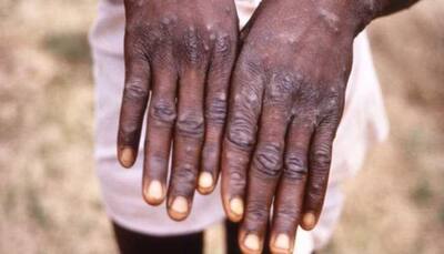 Monkeypox outbreak in 20 nations: Take quick steps to contain spread, says WHO, else...