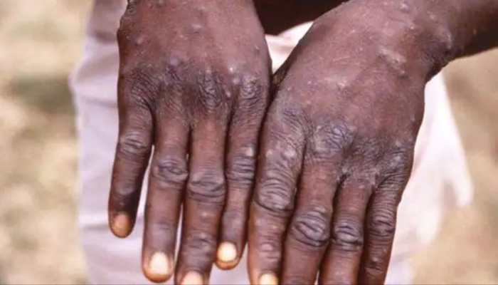 Monkeypox outbreak: India is prepared, no cases in country yet, says ICMR - Top points