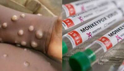 Monkeypox will never be eliminated but...': Report on rare virus reveals THIS