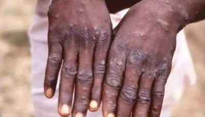 First Monkeypox death in Nigeria in 2022, 21 cases confirmed