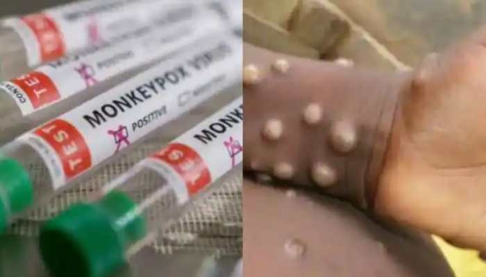 Monkeypox alert: India`s Health Ministry issues guidelines after 550 confirmed cases found in 30 non-endemic countries | India News | Zee News