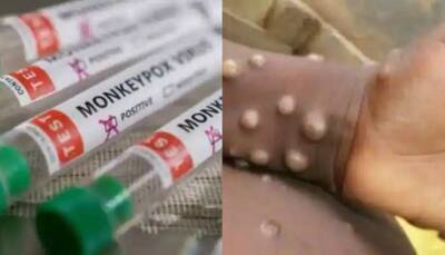 Monkeypox alert: India`s Health Ministry issues guidelines after 550 confirmed cases found in 30 non-endemic countries 