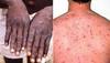 Monkeypox cases in world