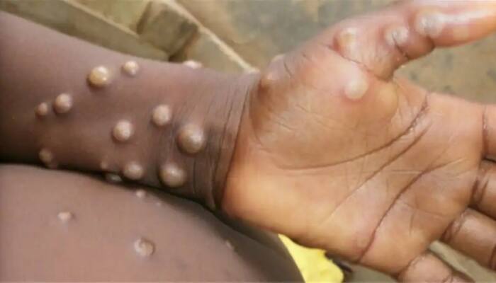 Monkeypox virus infected patient flees from hospital, THIS place on high alert