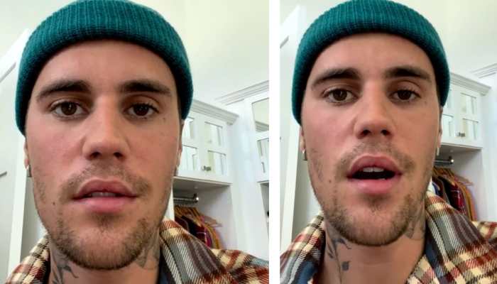 Justin Bieber's facial paralysis due to rare disorder Ramsay Hunt ...