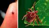 Kerala reports second scrub typhus death— Read symptoms, prevention tips here