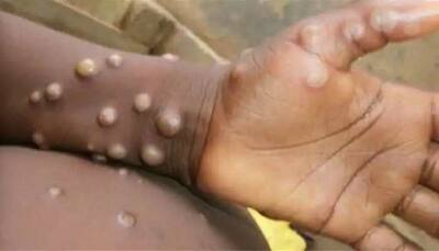 Monkeypox cases in Britain surpass 500