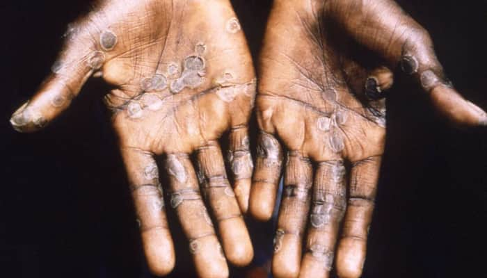 Suspected monkeypox case found in Nepal, patient has international travel history