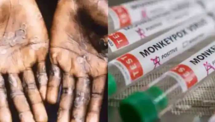 Monkeypox outbreak: Canada reports 168 cases amid global scare
