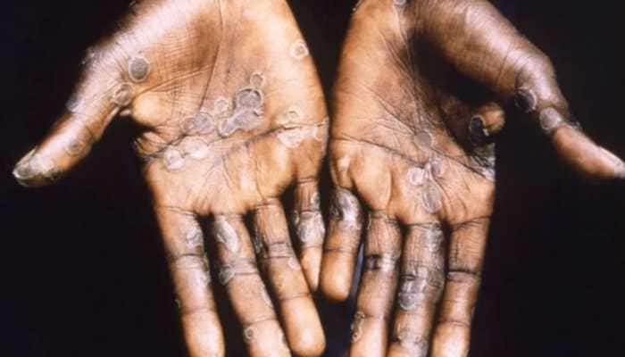 Monkeypox outbreak: New Zealand reports first case of monkeypox virus