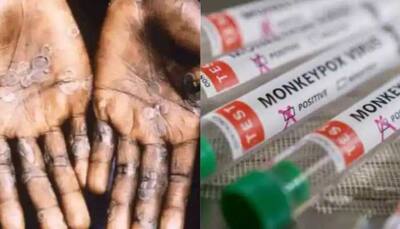 Monkeypox outbreak: Canada reports 477 cases amid global scare