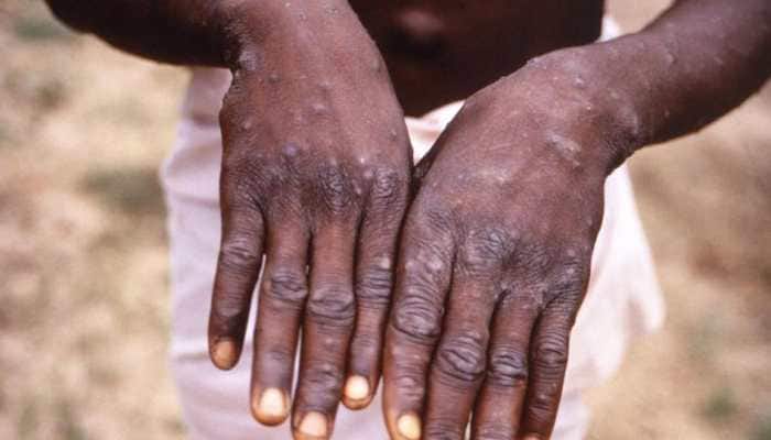 Monkeypox scare in India: Health Ministry issues new guidelines for management of disease