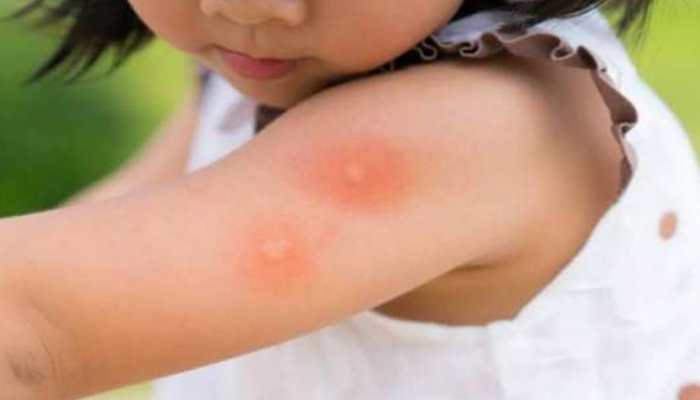 Tomato Fever fear grips Kerala: How to protect your children from viral infection? 