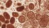 Monkeypox scare: Second positive case confirmed in Kerala's Kannur 