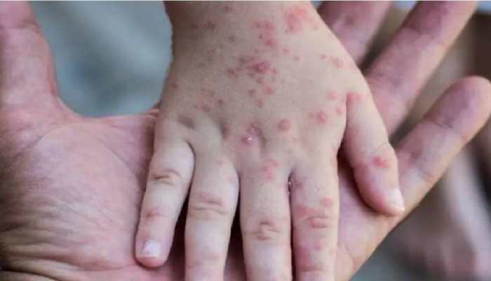 Monkeypox Virus India: These Creams and lotions from Africa are banned; DON'T make these mistakes, OTHERWISE...